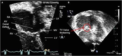 Case Report: A Rare Case of Right-Sided Papillary Fibroelastoma in a 1-Year-Old With Congenital Heart Disease